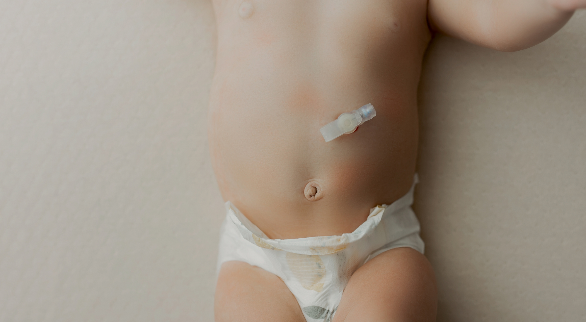 G Tube Weaning Help